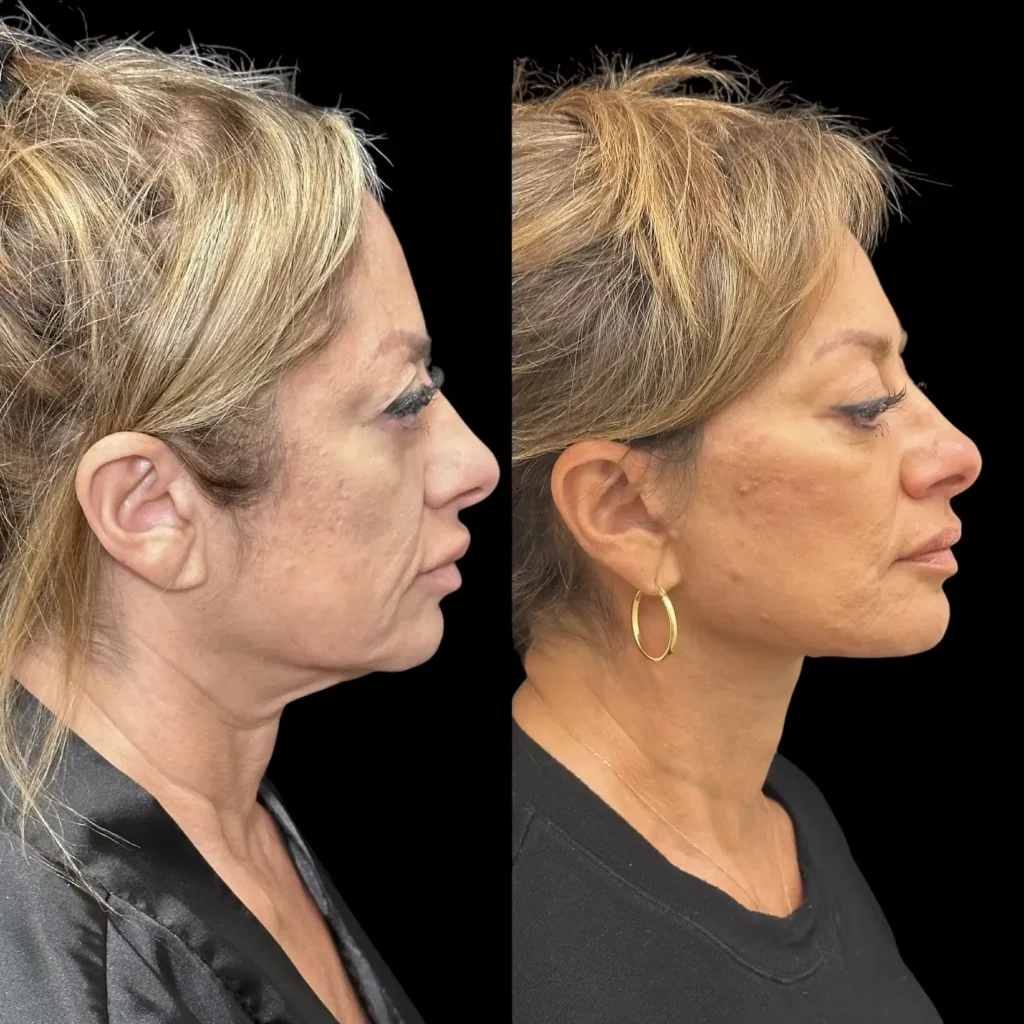 Neck Lift Before and After