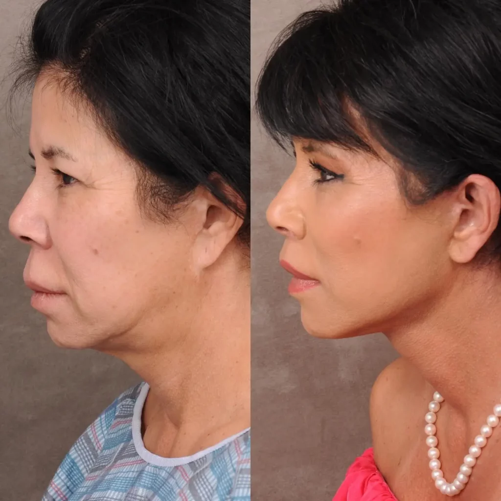 Neck Lift Before and After