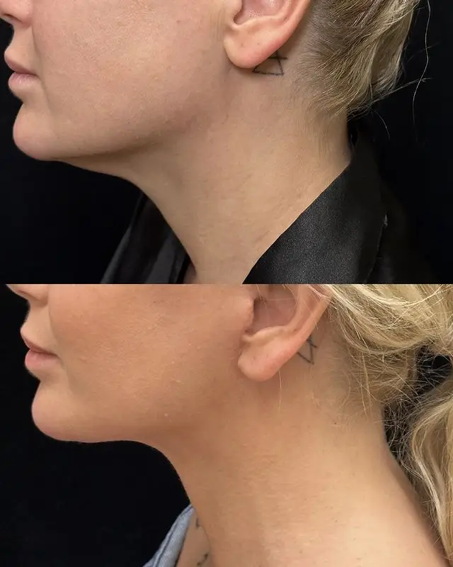 Neck Lift Before and After