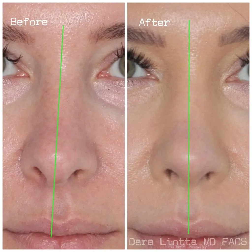 Septoplasty Before and After