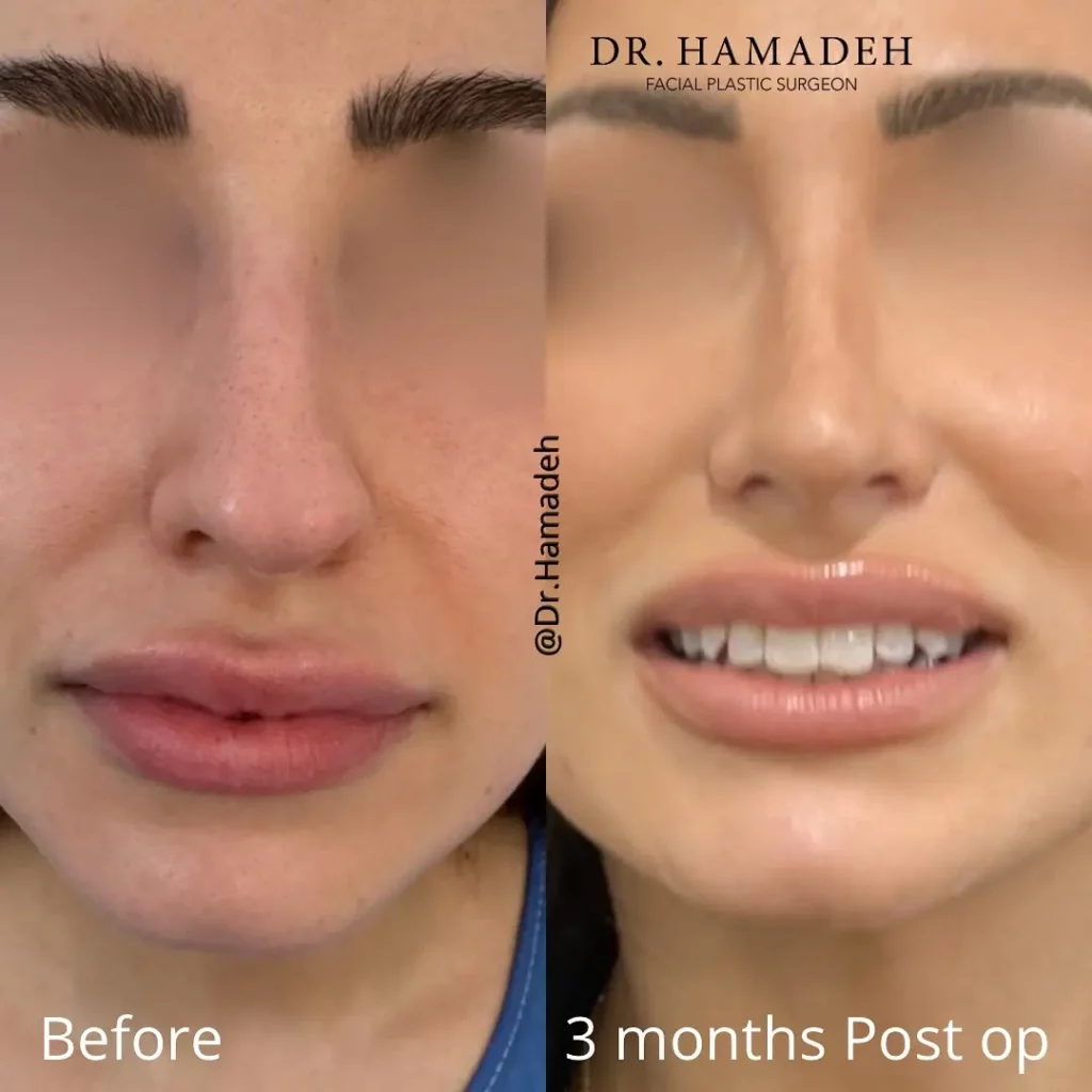 Septoplasty Before and After