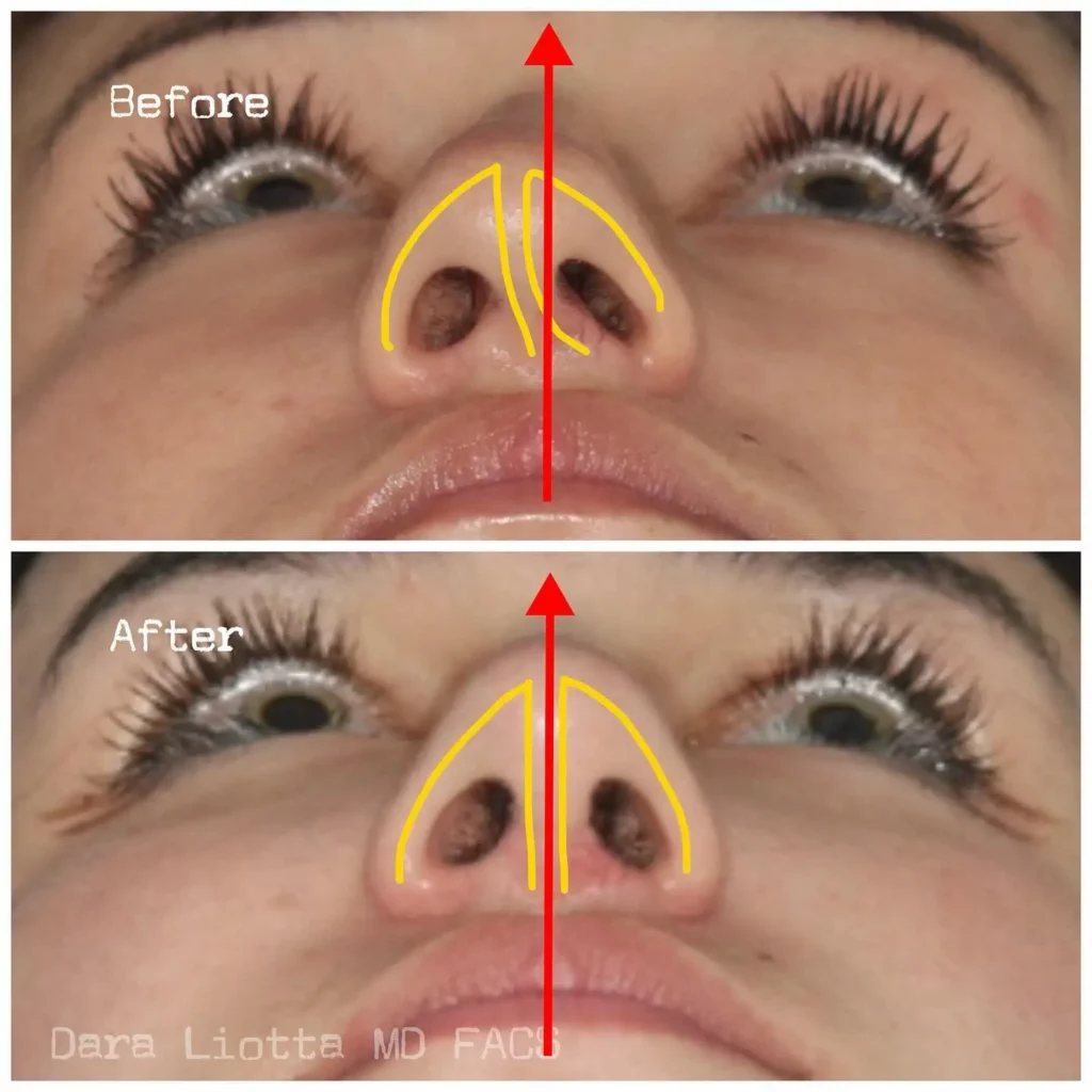 Septoplasty Before and After