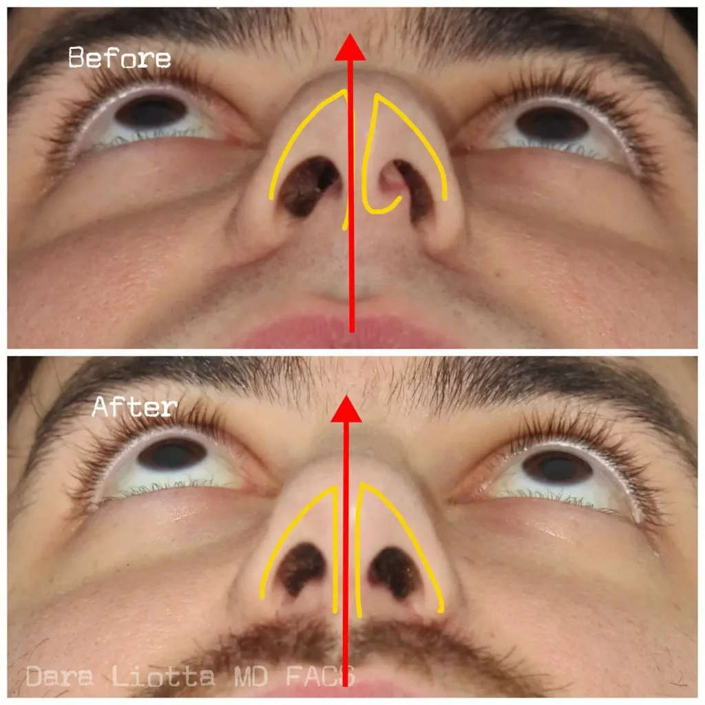 Septoplasty Before and After