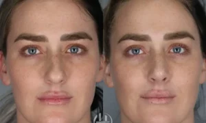 Septoplasty Before and After