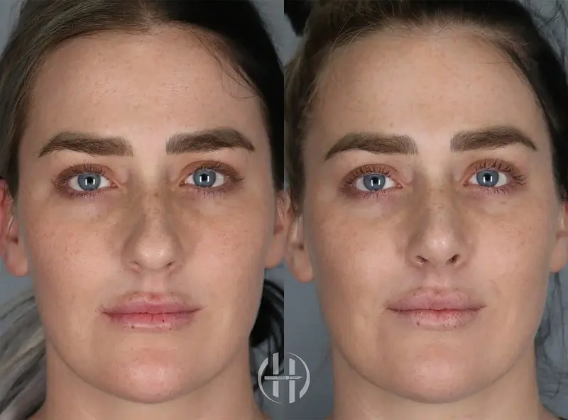 Septoplasty Before and After