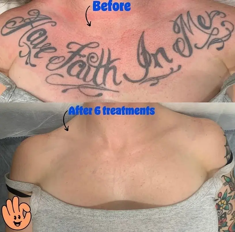 Tattoo Removal Before and After