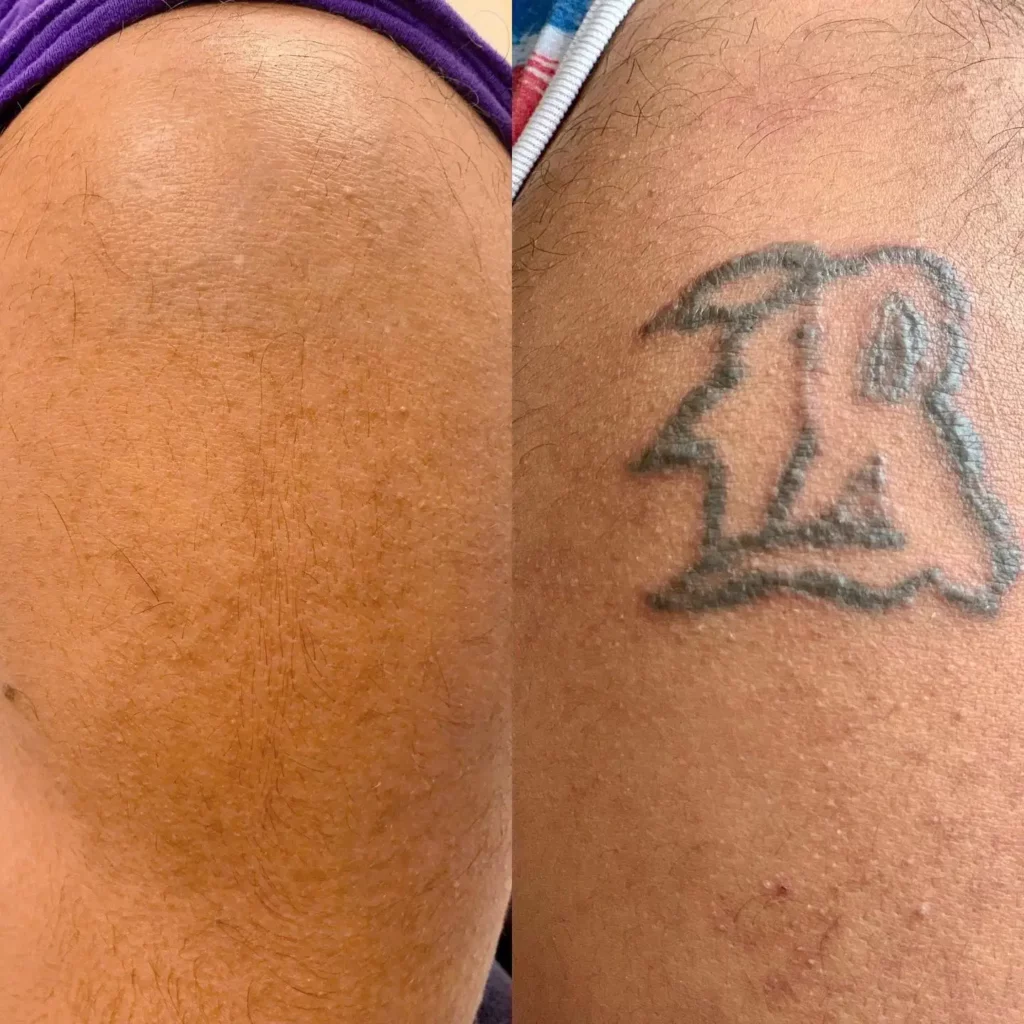 Tattoo Removal Before and After