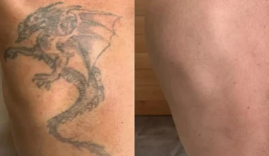 Tattoo Removal Before and After