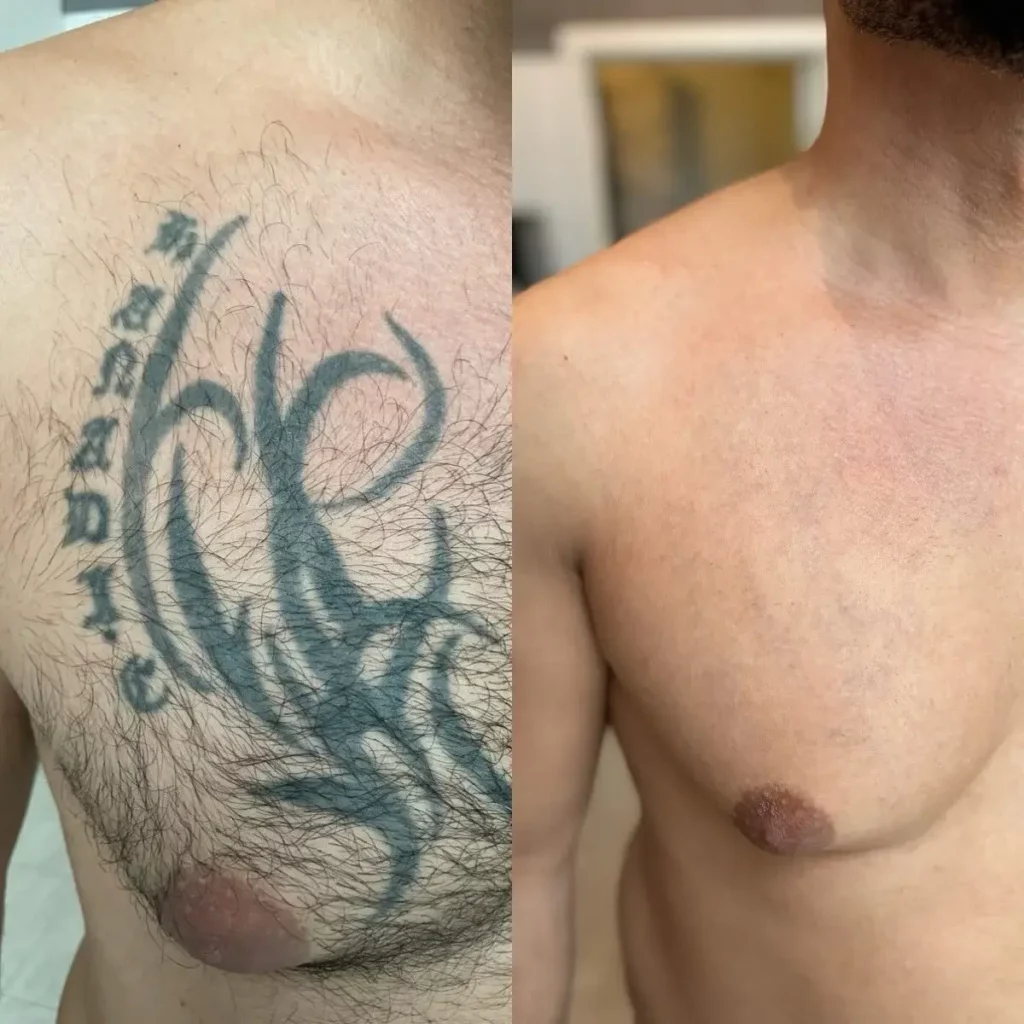 Tattoo Removal Before and After