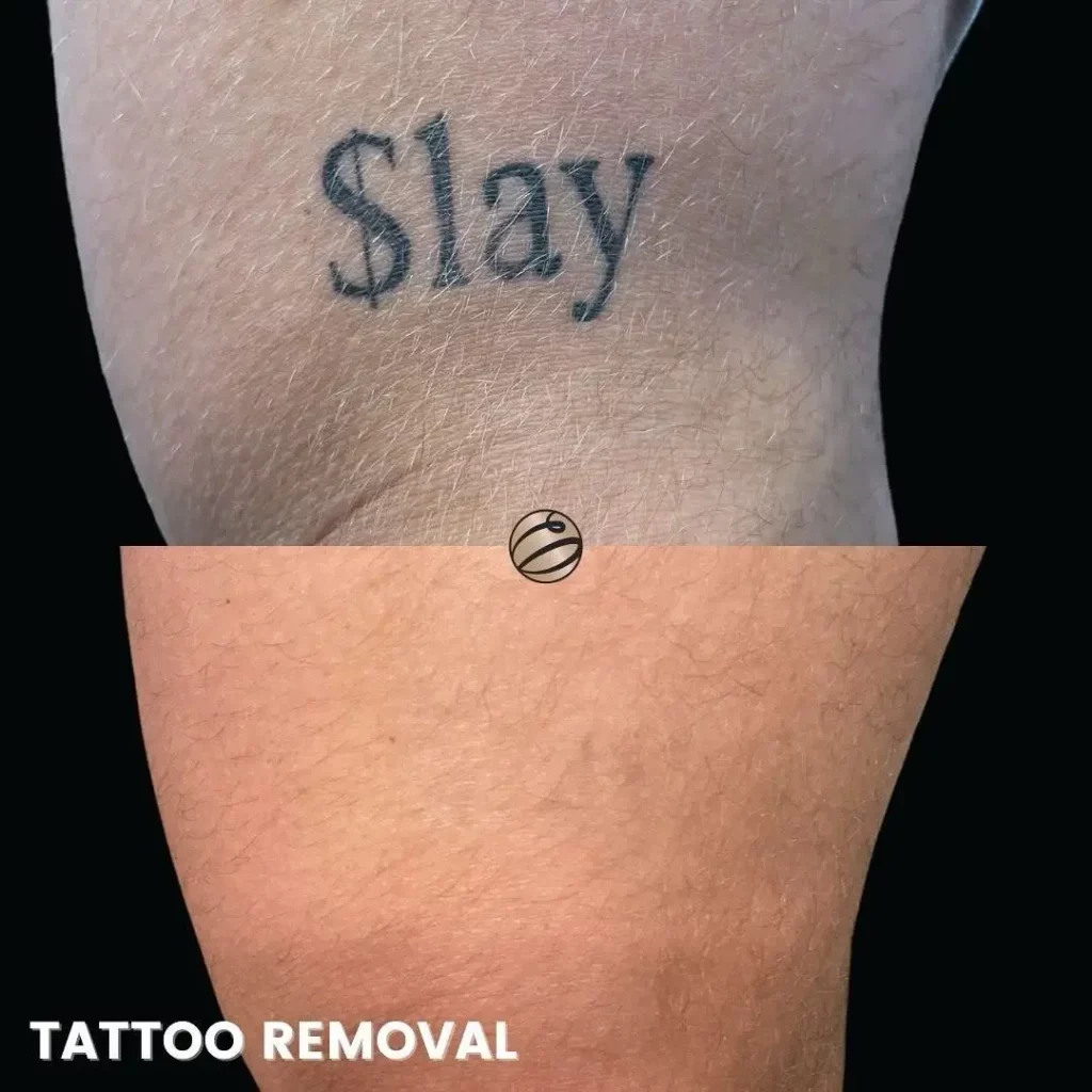 Tattoo Removal Before and After