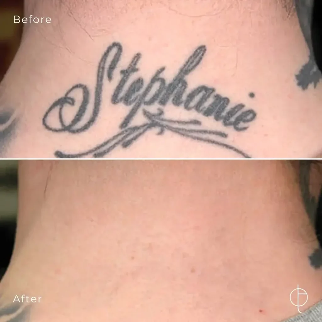 Tattoo Removal Before and After