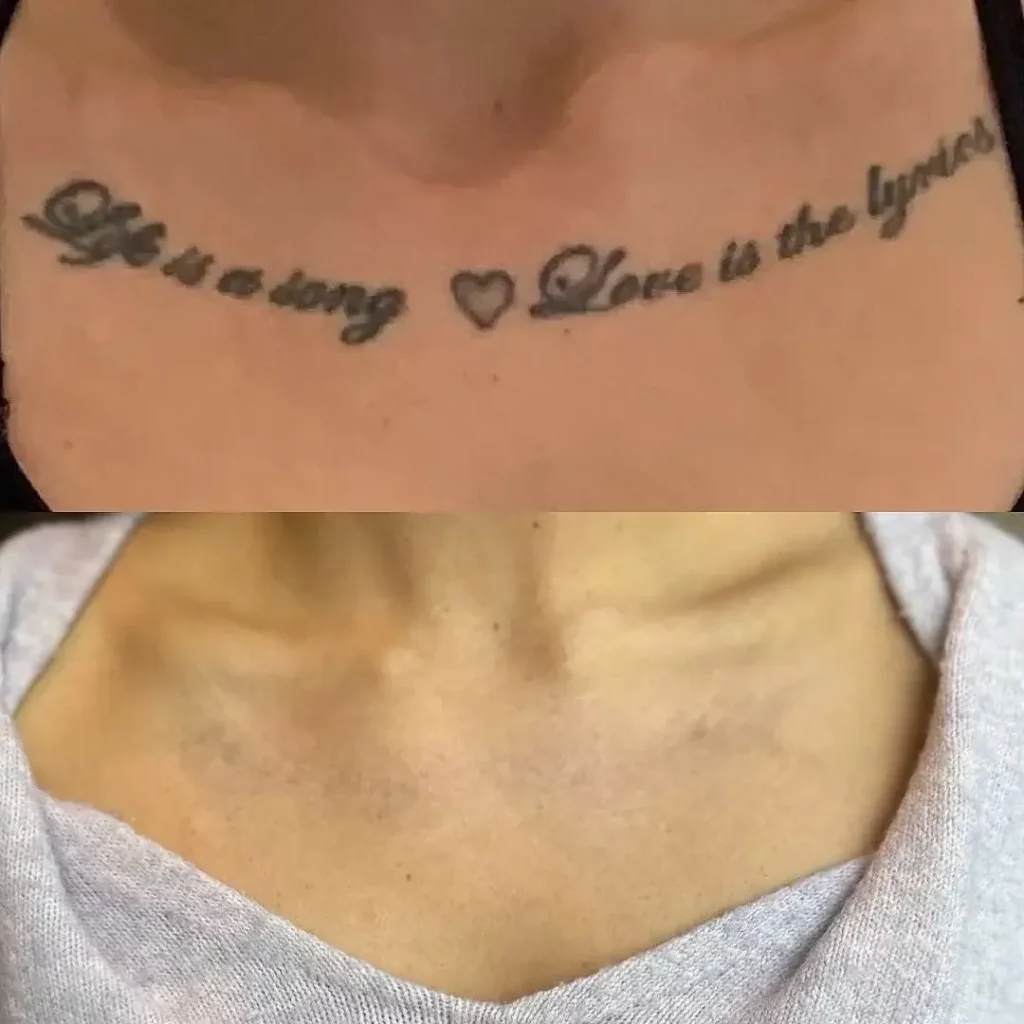 Tattoo Removal Before and After