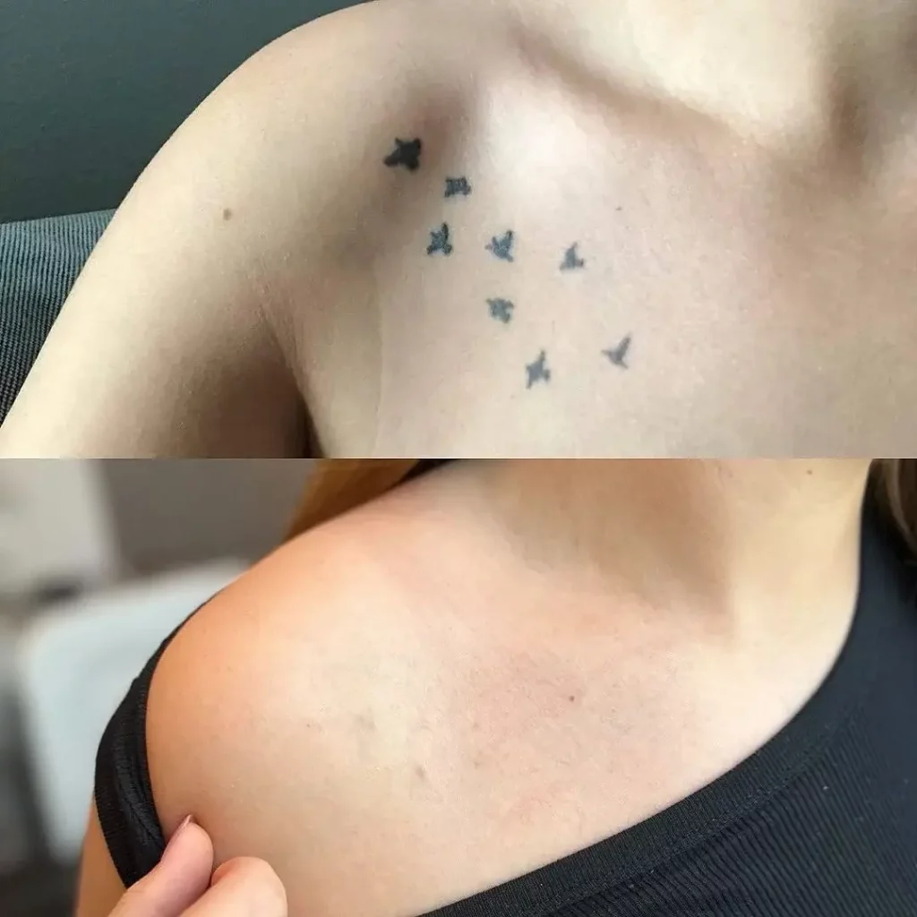 Tattoo Removal Before and After