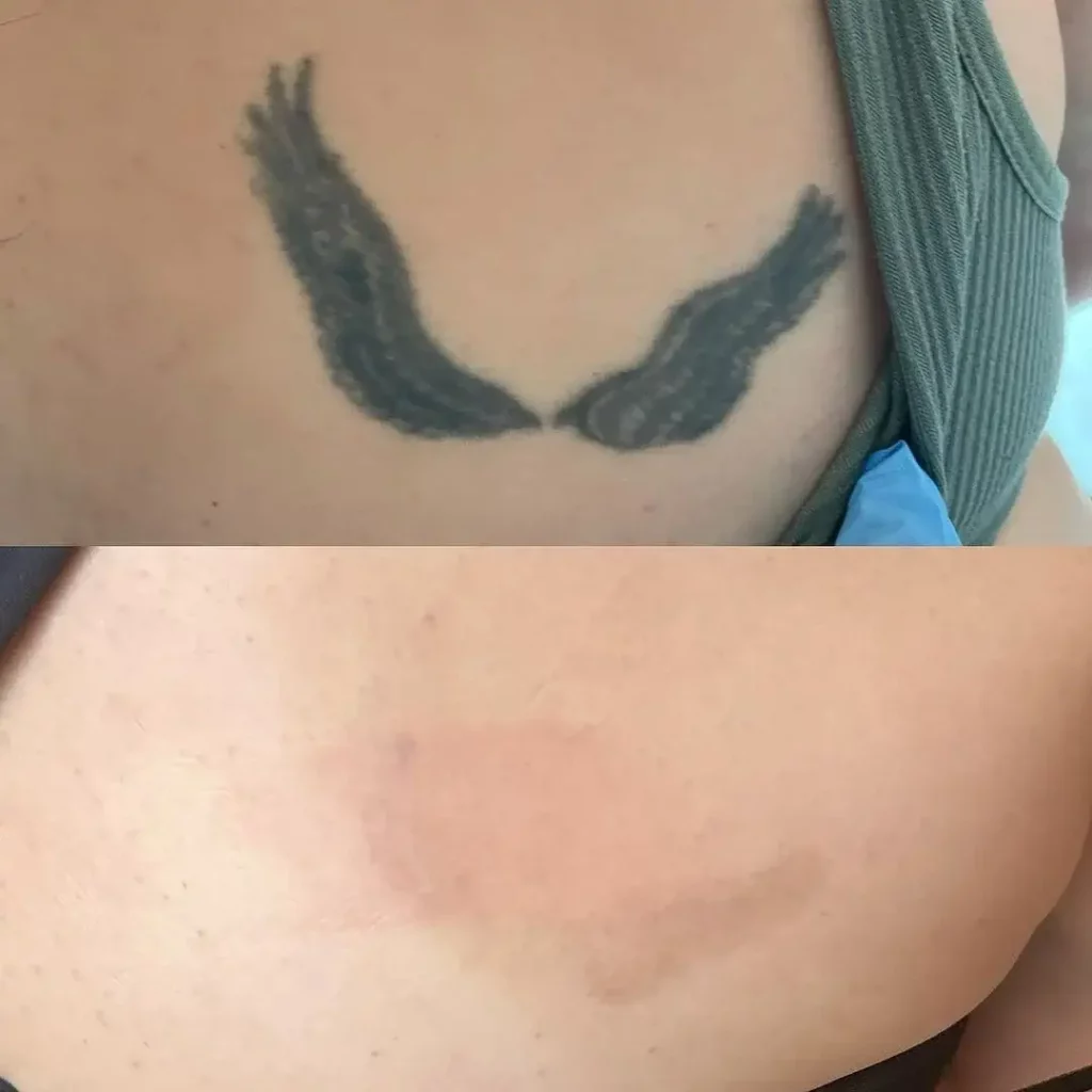 Tattoo Removal Before and After