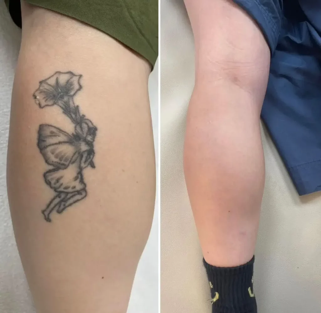 Tattoo Removal Before and After