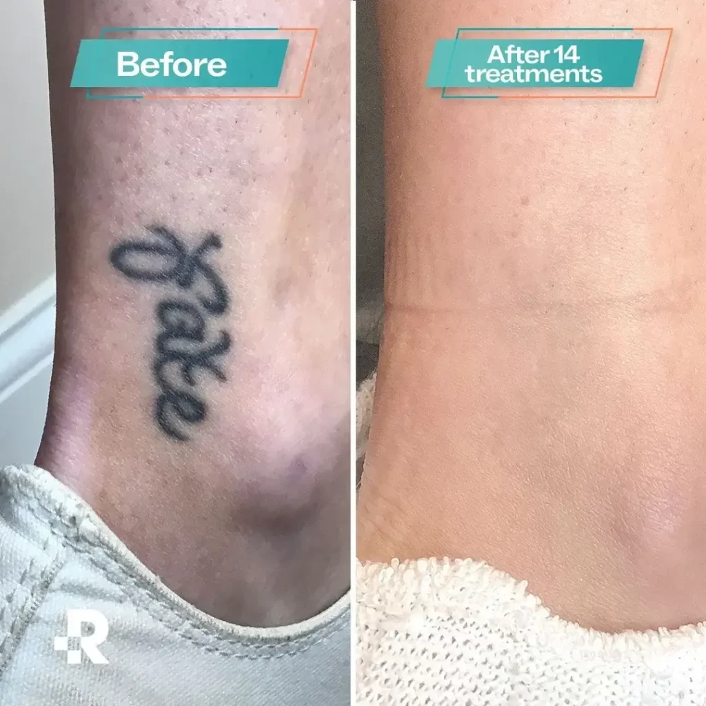 Tattoo Removal Before and After