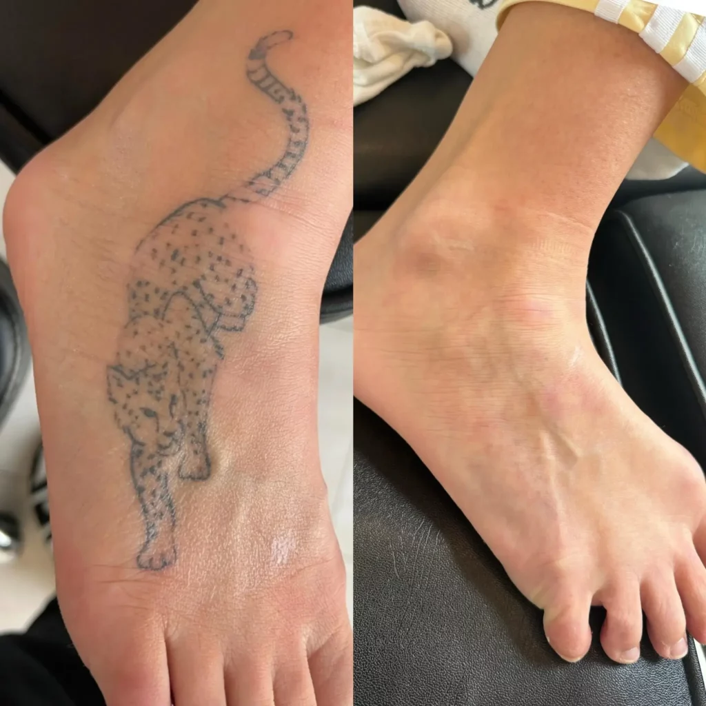 Tattoo Removal Before and After