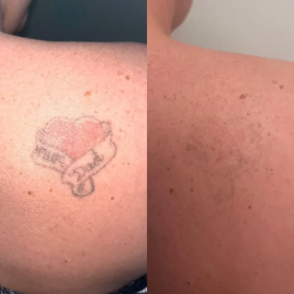 Tattoo Removal Before and After