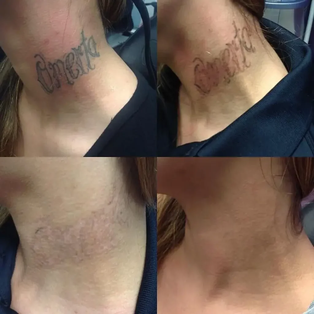 Tattoo Removal Before and After