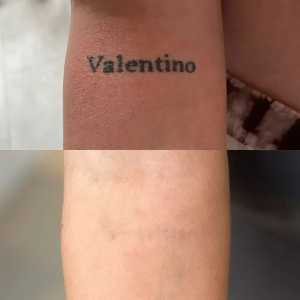 Tattoo Removal Before and After