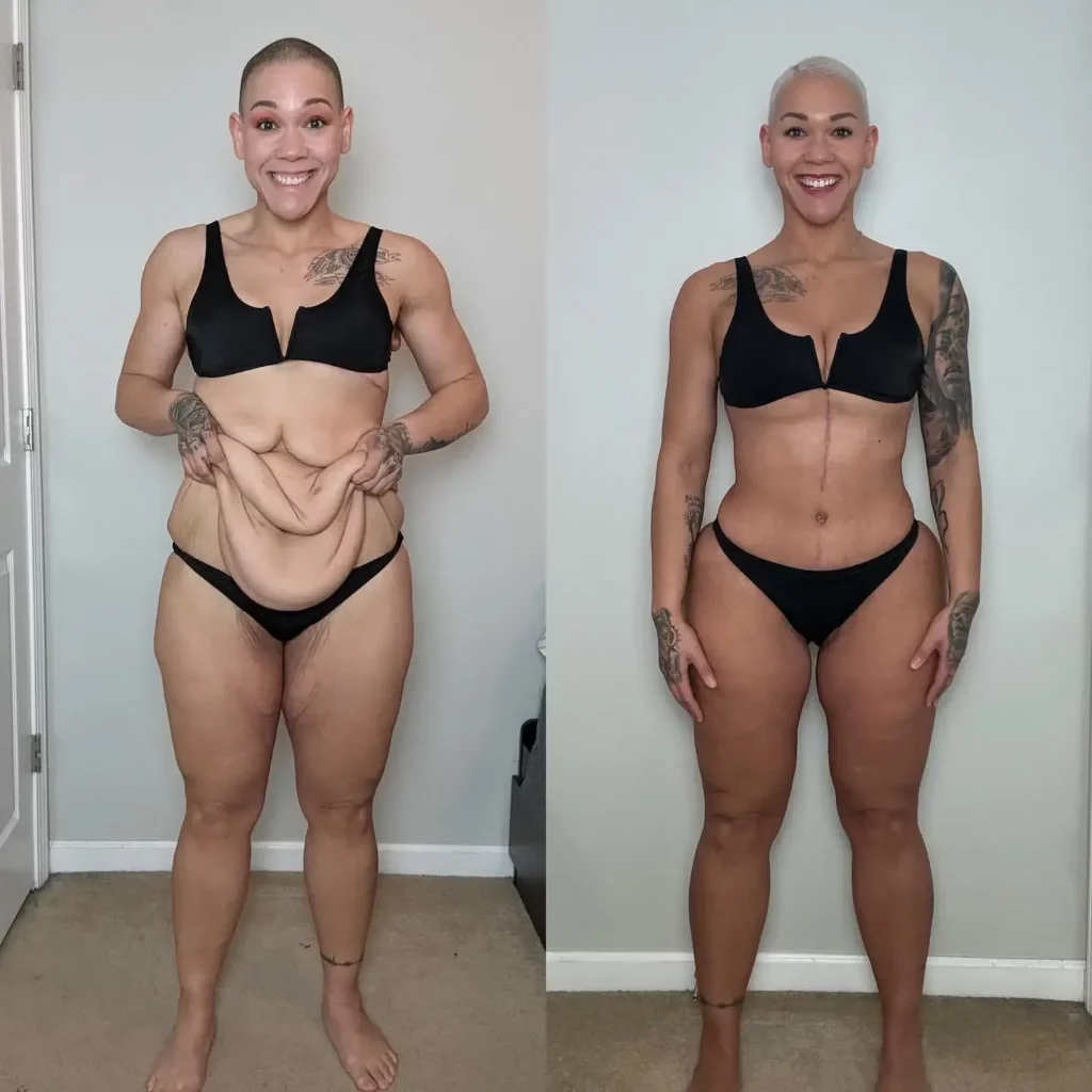 Tummy Tuck Before and After