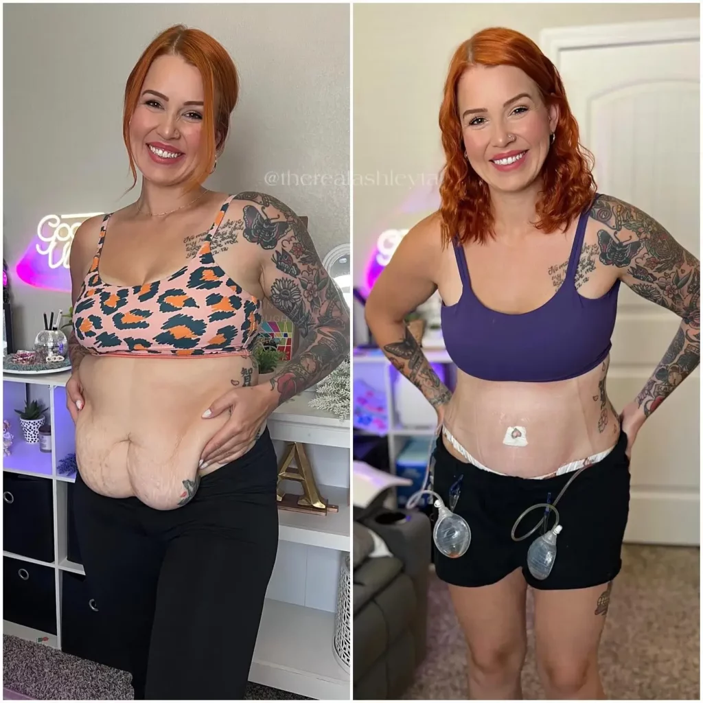 Tummy Tuck Before and After