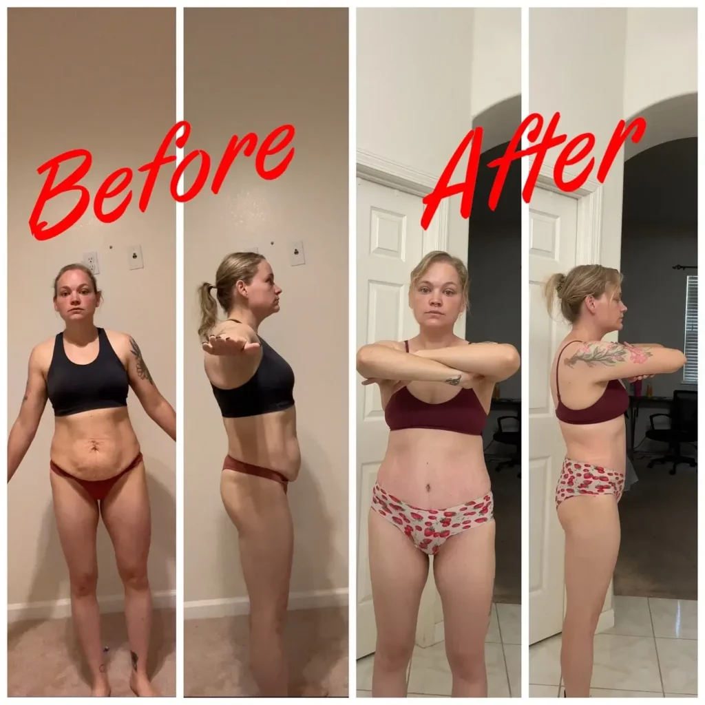 Tummy Tuck Before and After