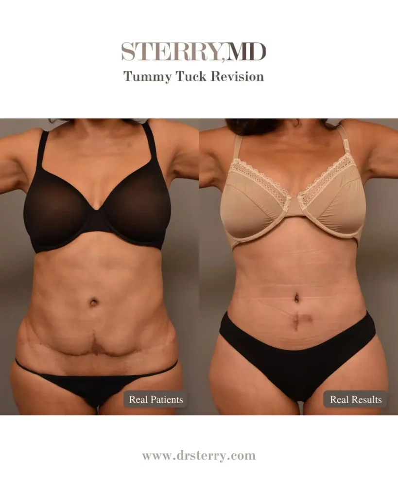 Tummy Tuck Before and After