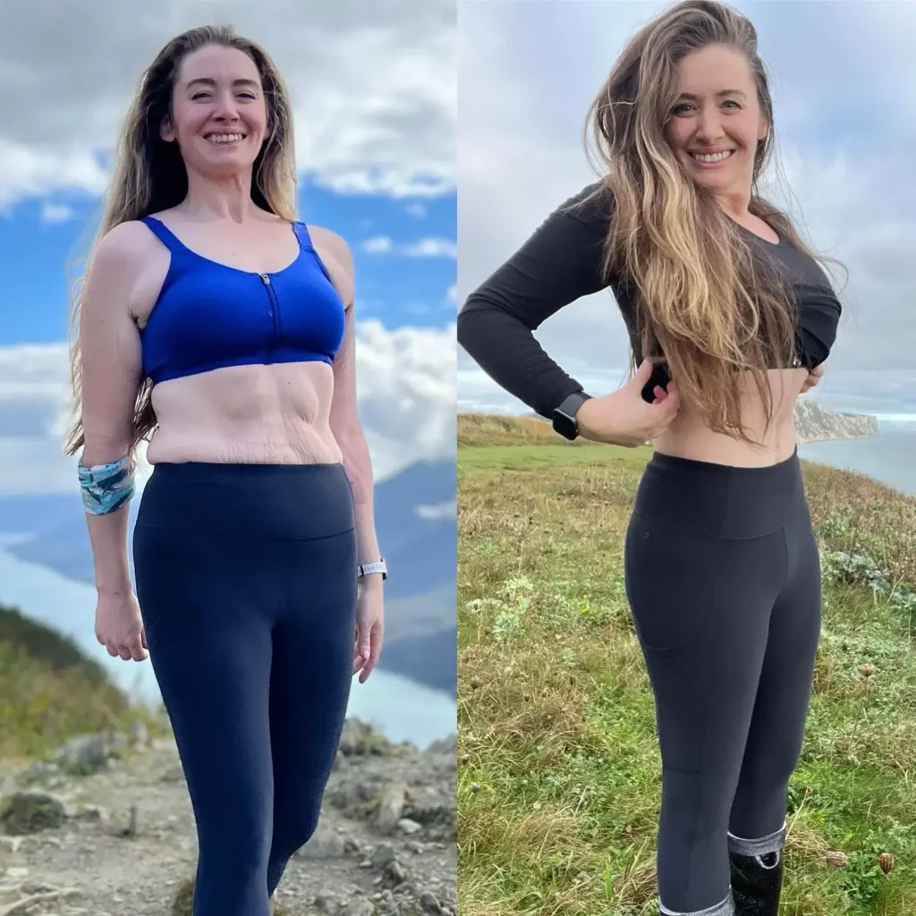 Tummy Tuck Before and After