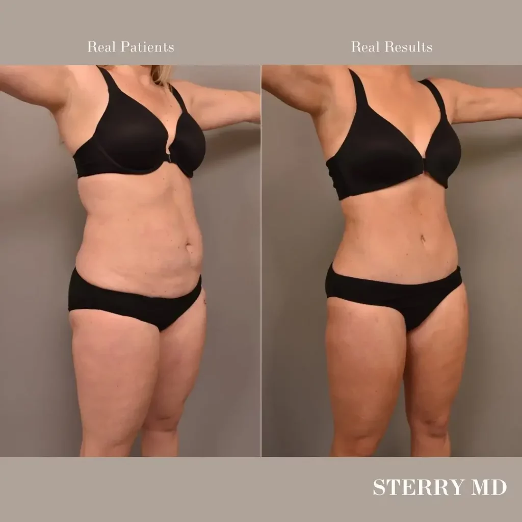 Tummy Tuck Before and After