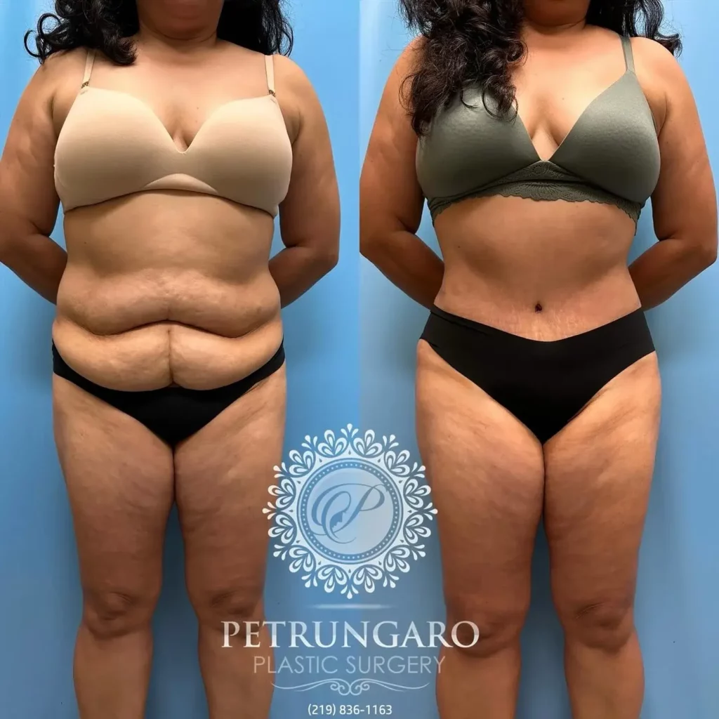 Tummy Tuck Before and After