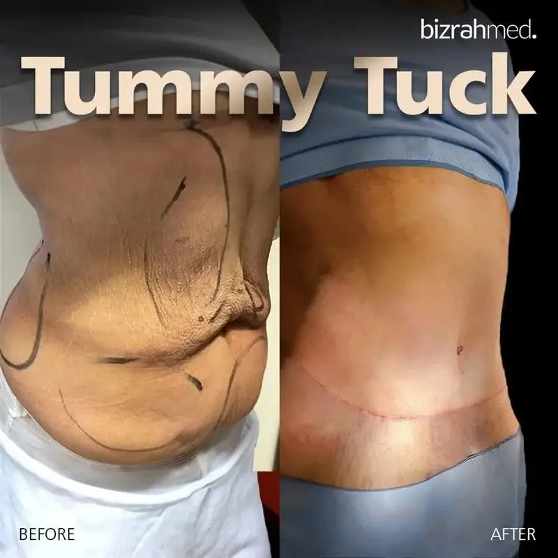 Tummy Tuck Before and After