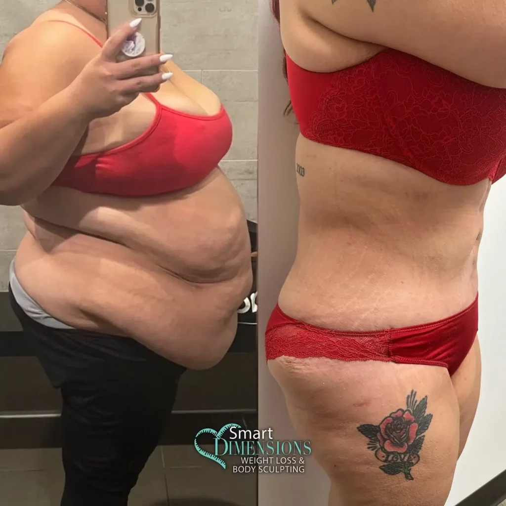 Tummy Tuck Before and After