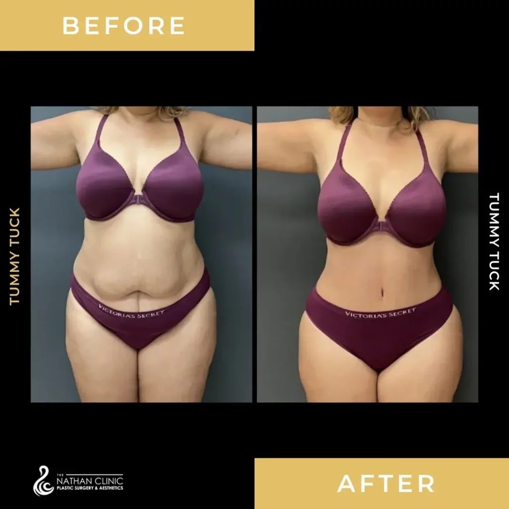 Tummy Tuck Before and After