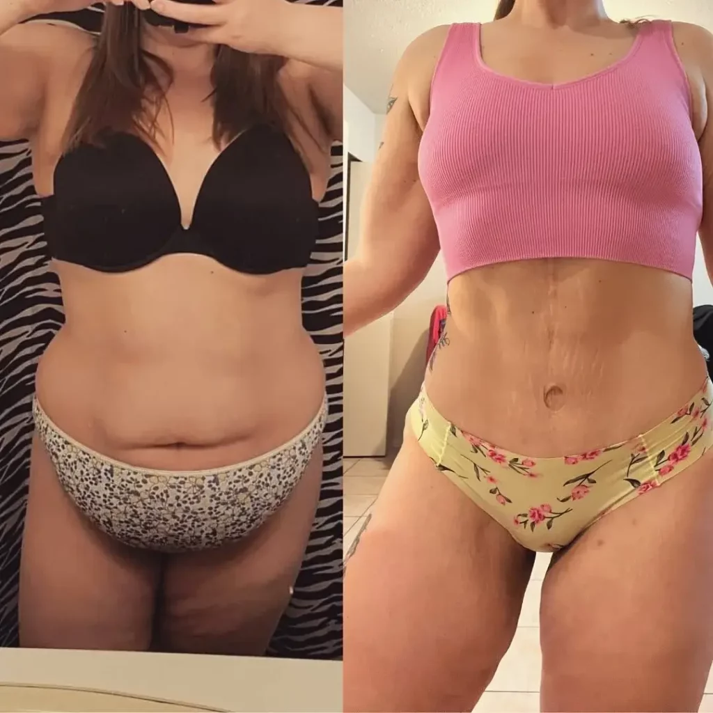 Tummy Tuck Before and After