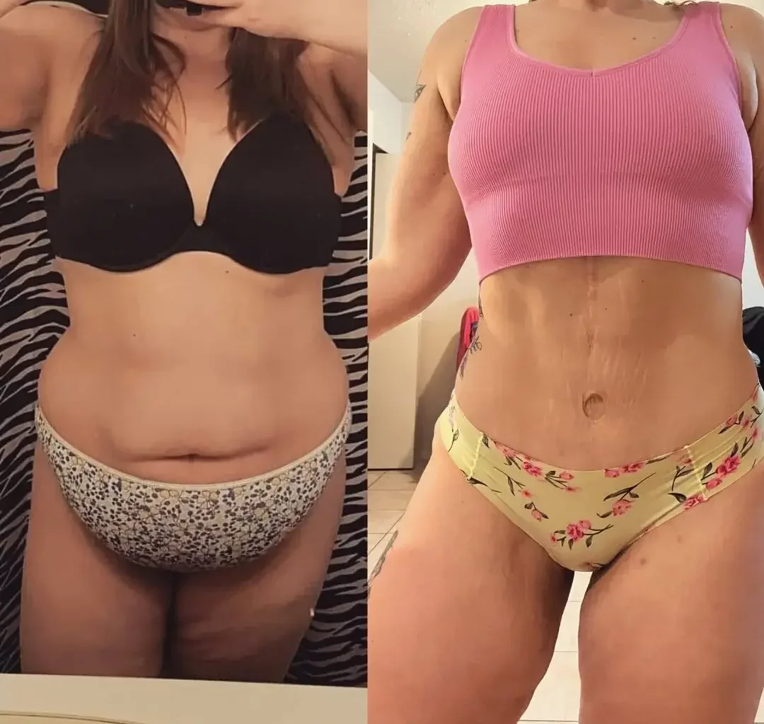 Tummy Tuck Before and After