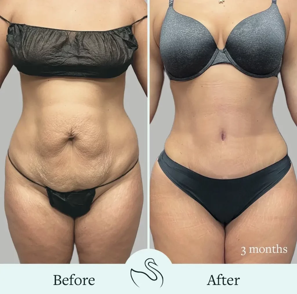 Tummy Tuck Before and After