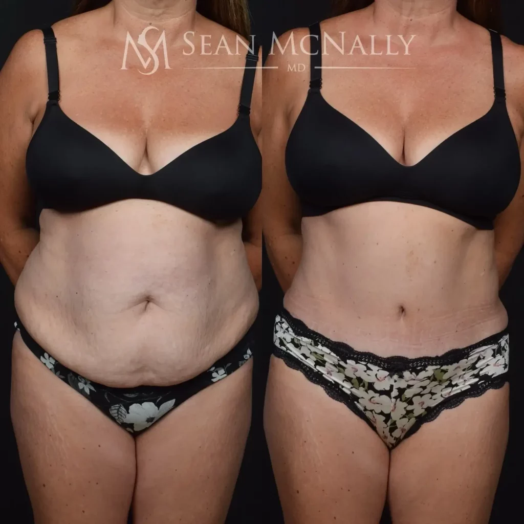 Tummy Tuck Before and After