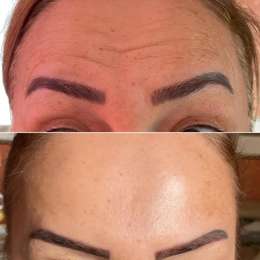 Botox Before and After