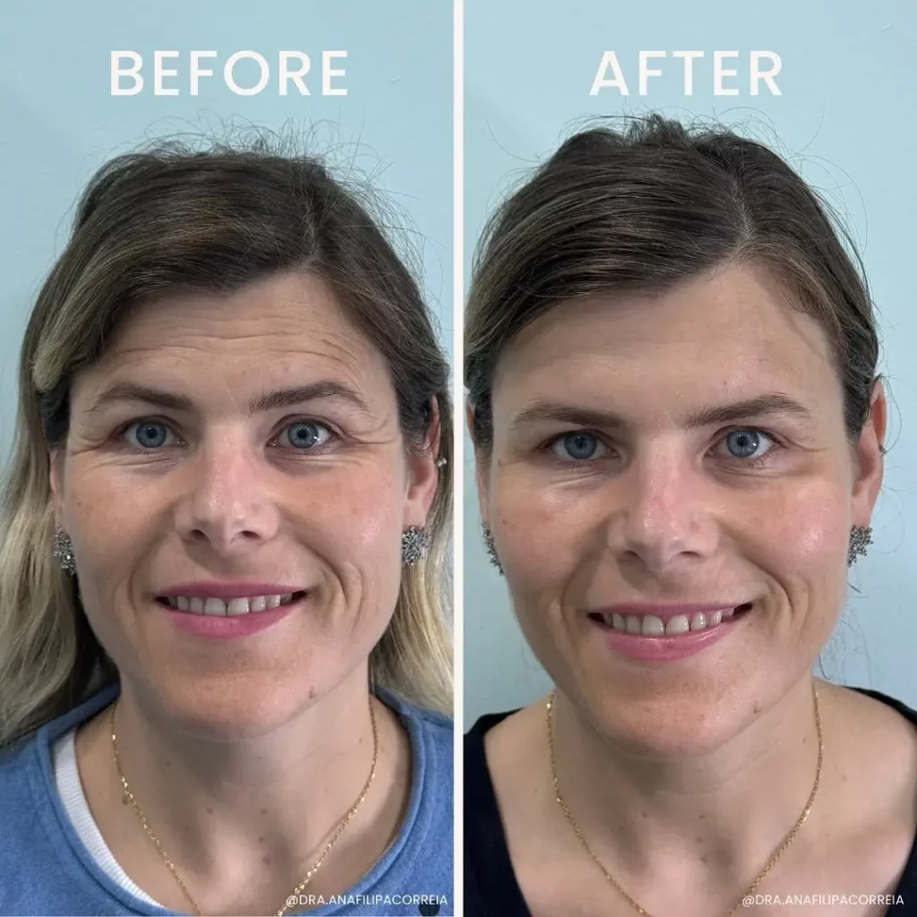 Botox Before and After