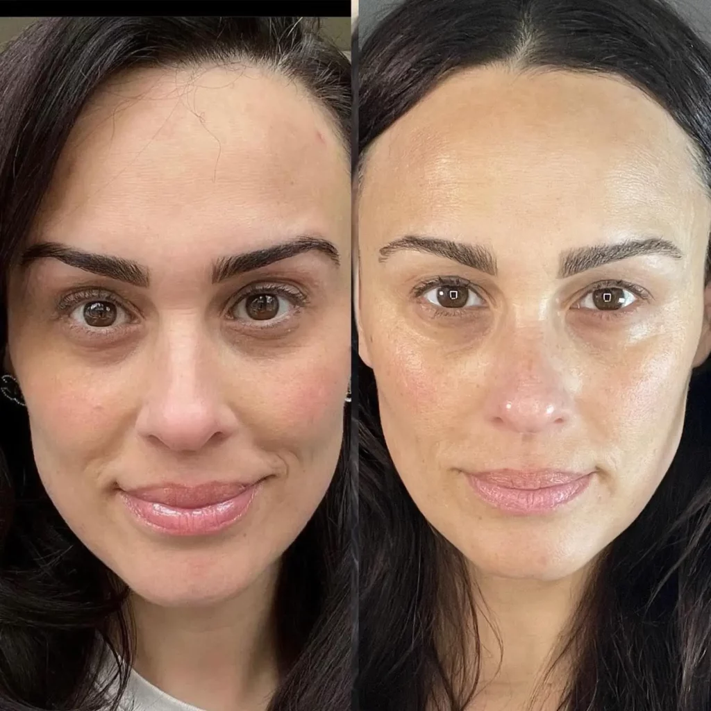 Botox Before and After