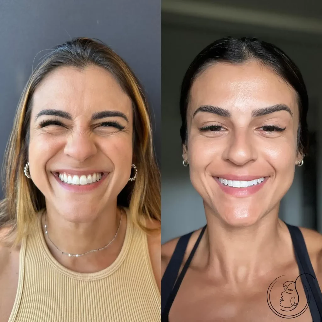 Botox Before and After