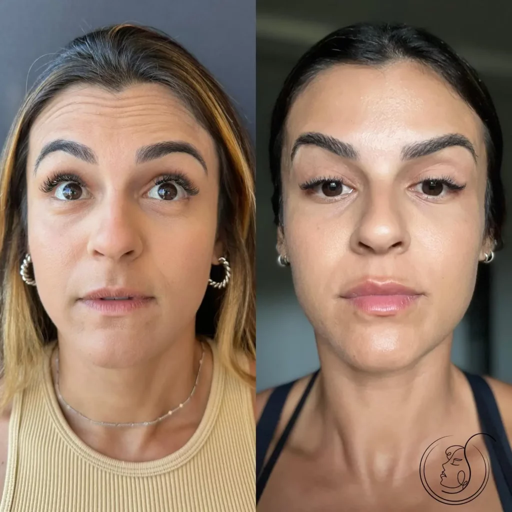 Botox Before and After