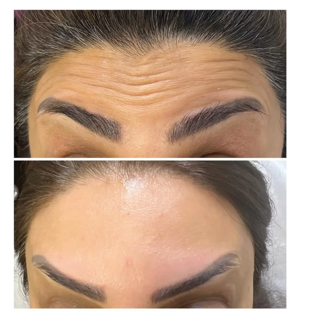 Botox Before and After