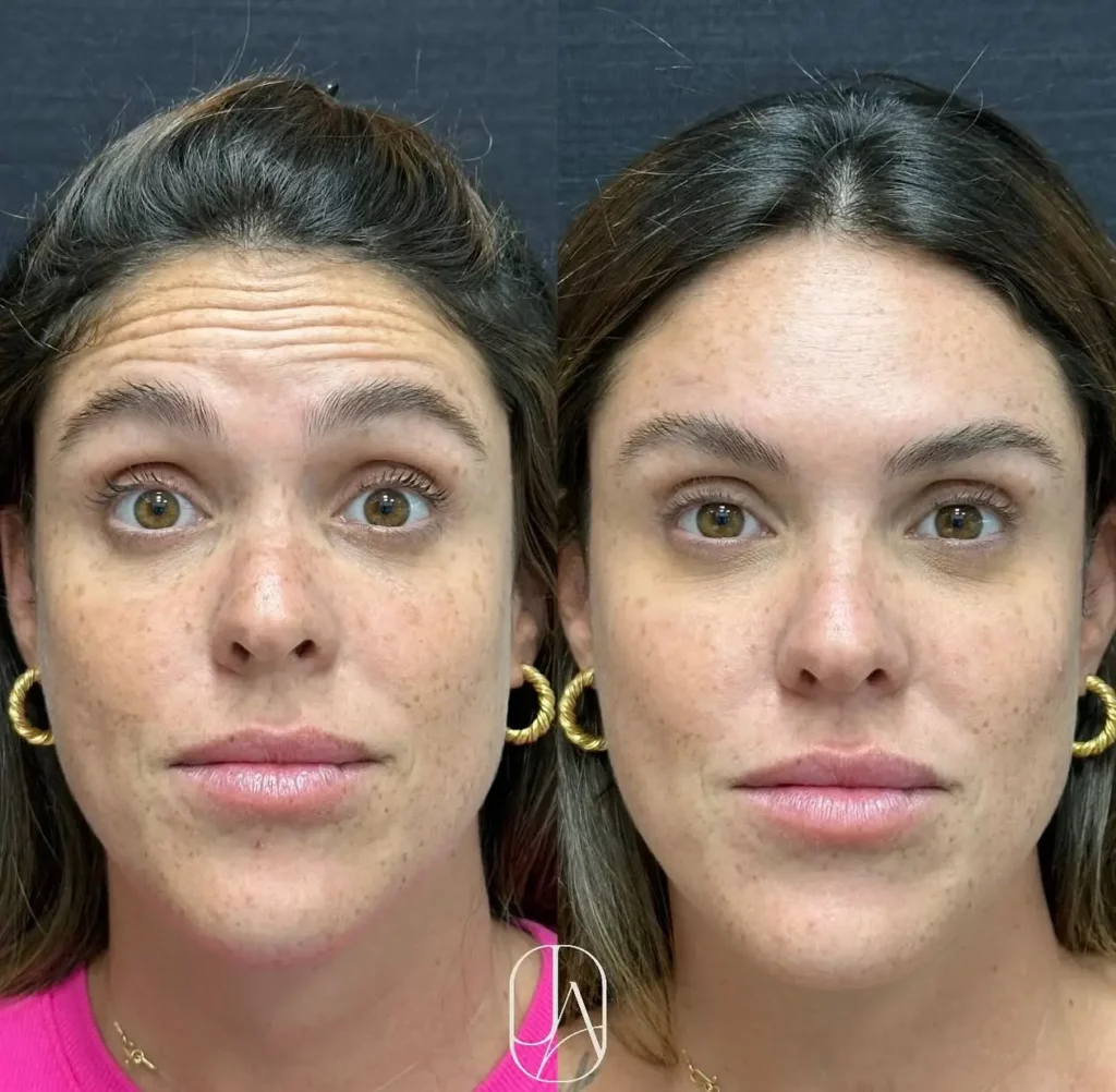 Botox Before and After