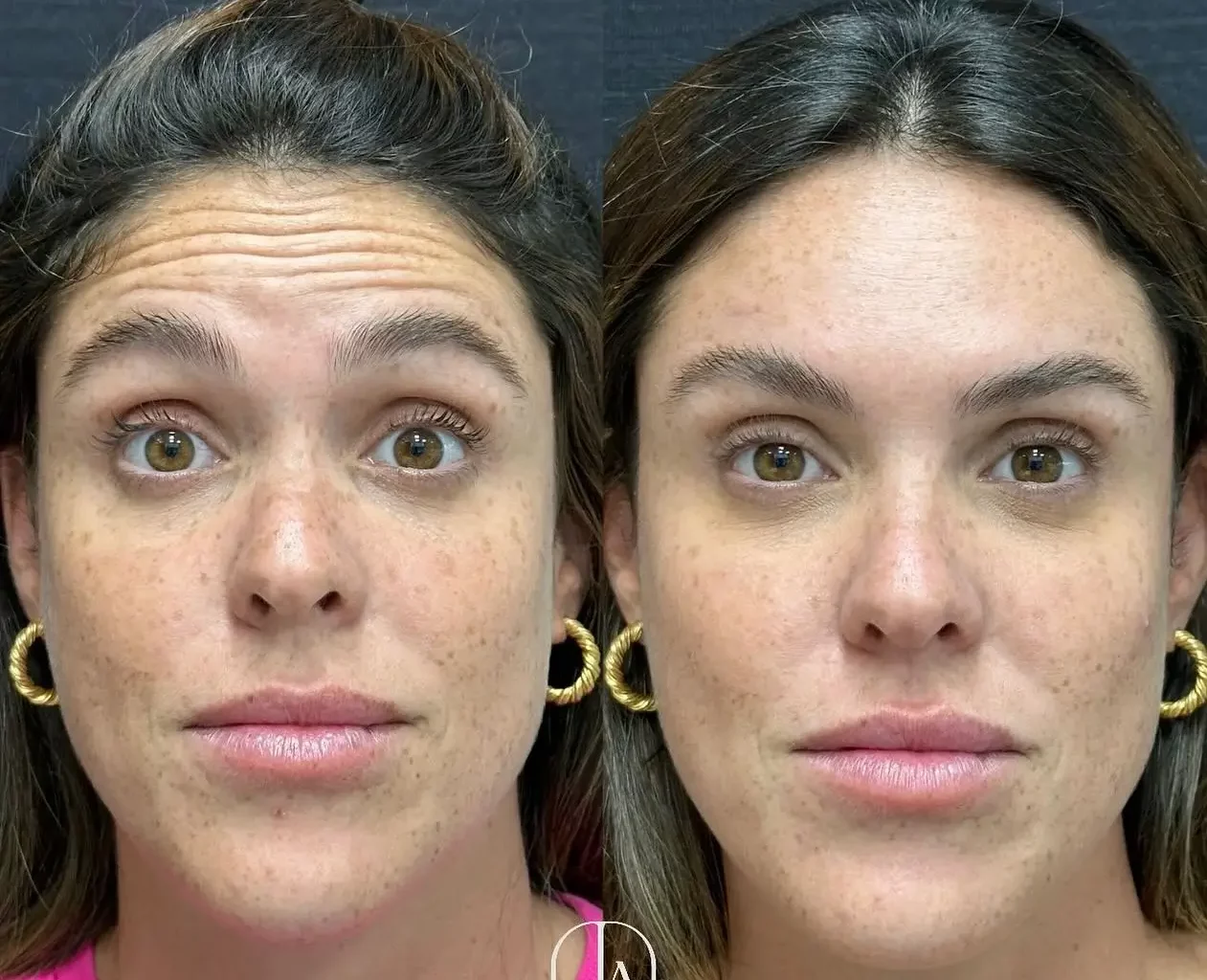 Botox Before and After