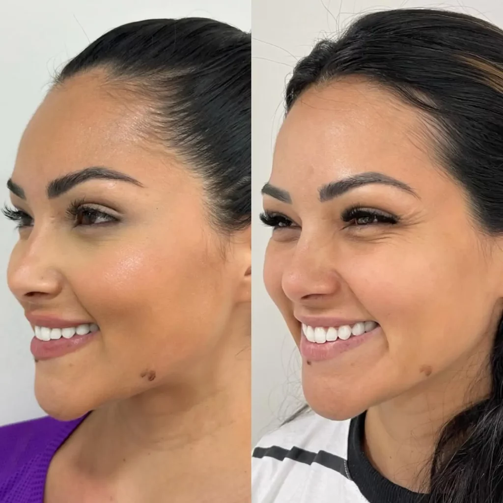 Botox Before and After