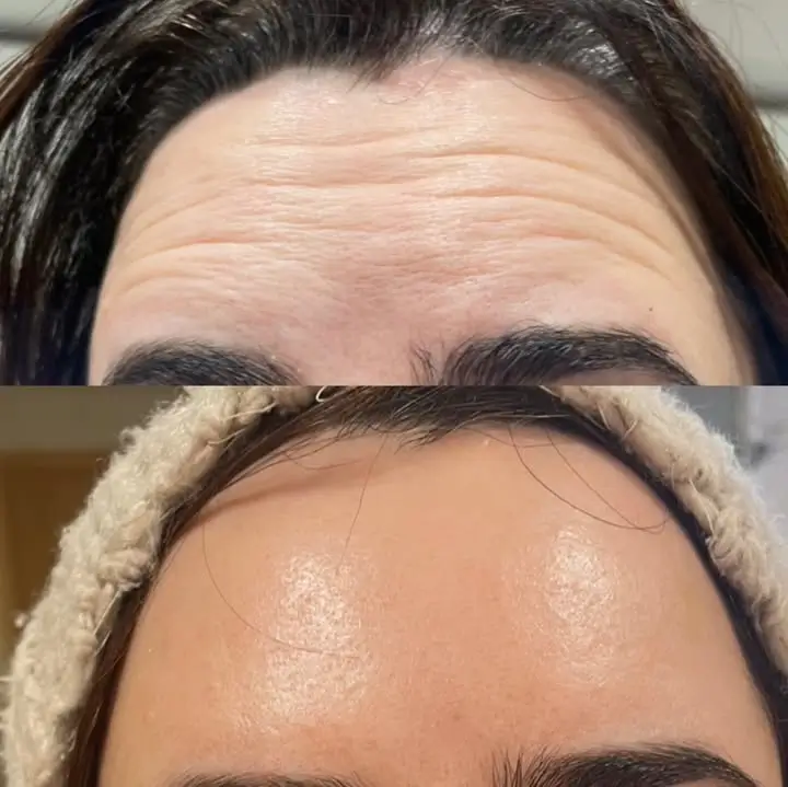 Botox Before and After