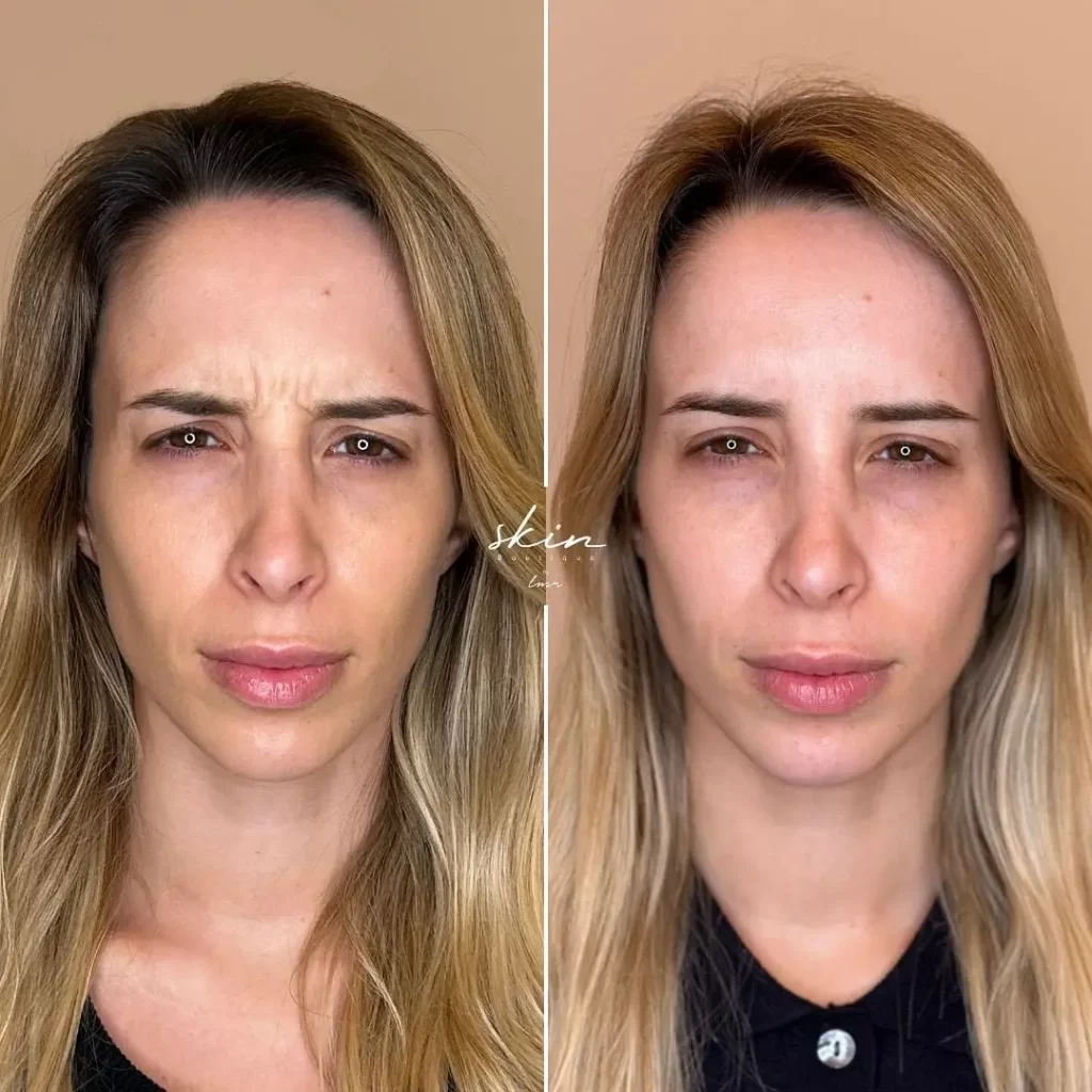 Botox Before and After