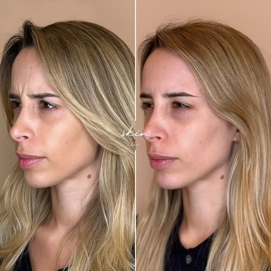 Botox Before and After